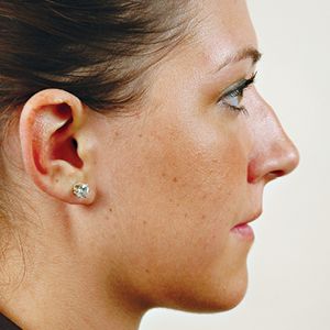 Side view of patient before nose surgery