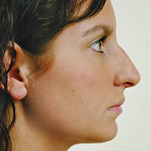 Side view of patient before nose surgery
