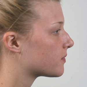 Side view of patient before nose surgery