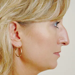 Side view of patient before nose surgery