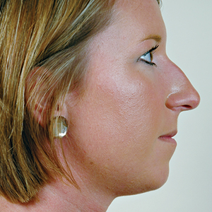 Side view of patient before nose surgery