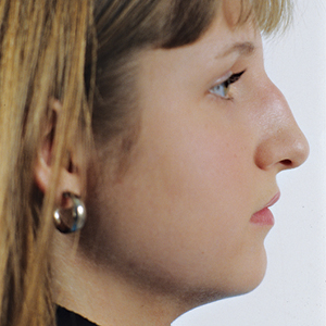 Side view of patient before nose surgery