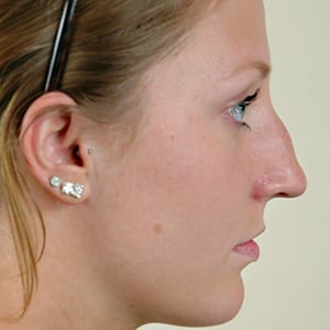 Side view of patient before nose surgery