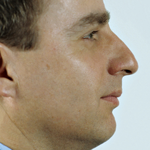 Side view of patient before nose surgery