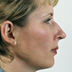 Side view of patient before nose surgery