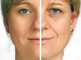 Side by side before and after of facelift surgery