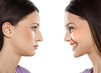 Side by side before and after of nose surgery