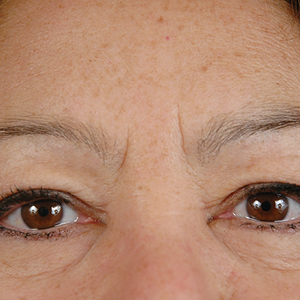 Forehead of patient before BOTOX treatment