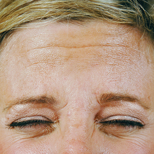Forehead of patient before BOTOX treatment