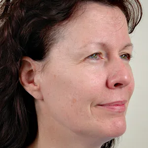 Patient before brow lift surgery
