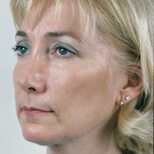 Patient before brow lift surgery