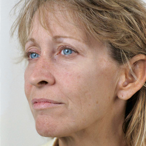 Patient before brow lift surgery
