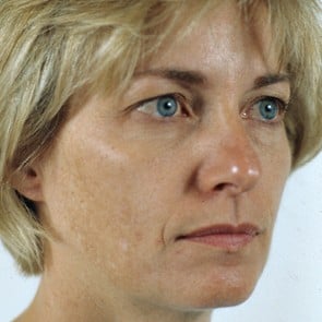 Patient before eyelid lift surgery
