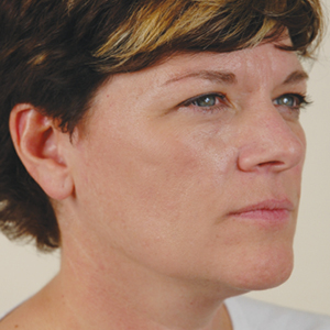 Patient before eyelid lift surgery