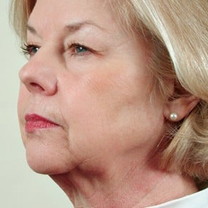 Patient before eyelid lift surgery