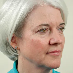 Patient before eyelid lift surgery