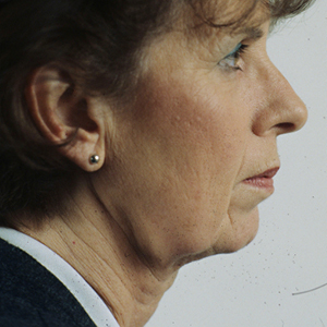 Side view of patient before facelift surgery