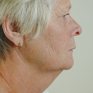 Side view of patient before facelift surgery