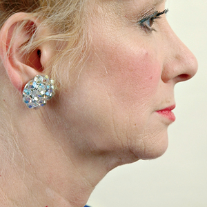 Side view of patient before facelift surgery