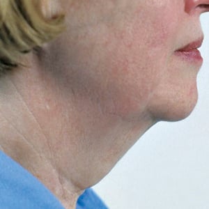 Side view of patient before facelift surgery