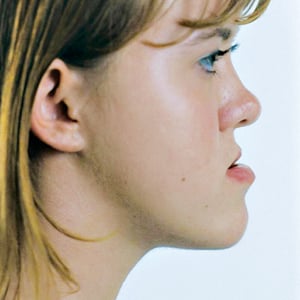 Side view of patient before jaw surgery