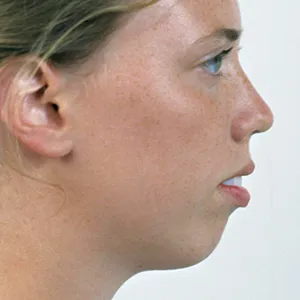 Side view of patient before jaw surgery