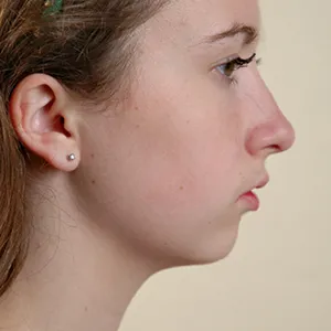 Side view of patient before jaw surgery