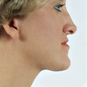 Side view of patient before jaw surgery
