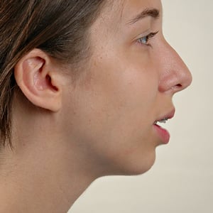 Side view of patient before jaw surgery