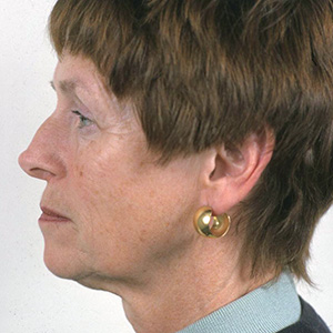 Side view of patient before facelift surgery