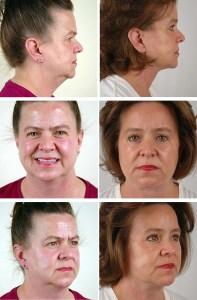 Multiple views of patients before and after facelift surgery